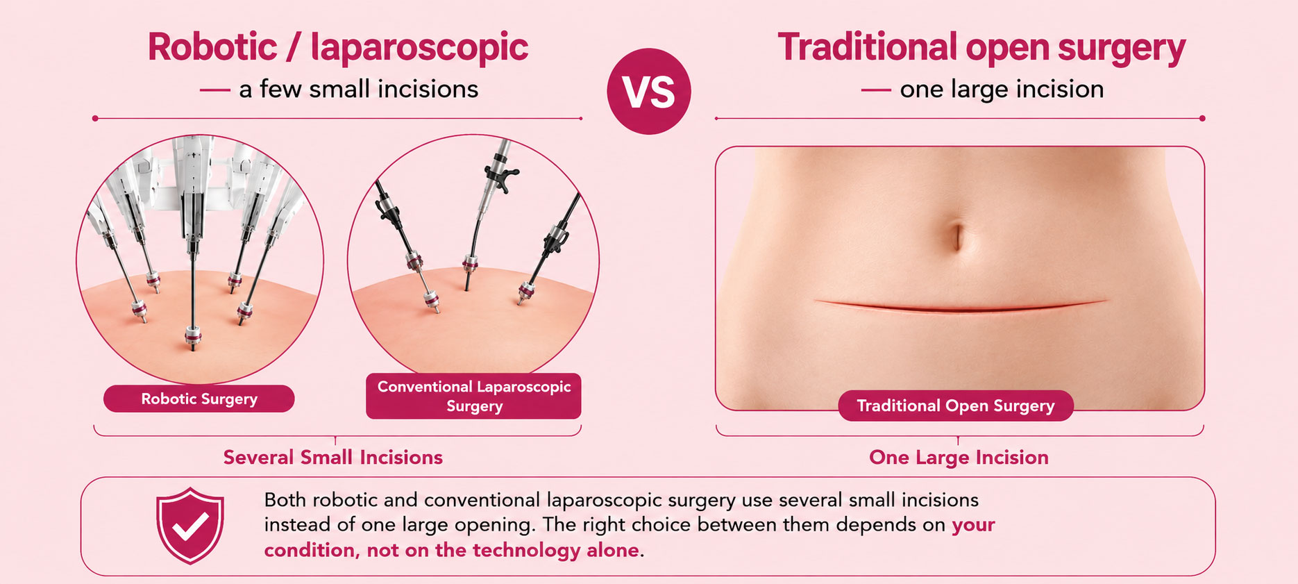 Robotic surgery or laparoscopic surgery